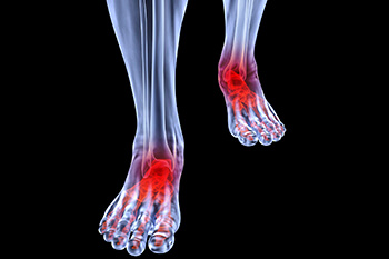 Arthritic foot and ankle care treatment, foot arthritis treatment in the Queens County, NY: Ozone Park (Forrest Hills, Howard Beach, Jamaica, East New York, Hollis, Laurelton, Flushing, Elmhurst, Elmont, Bushwick, Williamsburg) and Nassau County, NY: Manhasset (Great Neck, Garden City, Mineola, Westbury, Roslyn, Jericho, Hempstead, Hicksville, Glen Cove, East Meadow) areas