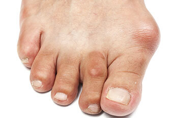 Professional Bunions treatment in the Queens County, NY: Ozone Park (Forrest Hills, Howard Beach, Jamaica, East New York, Hollis, Laurelton, Flushing, Elmhurst, Elmont, Bushwick, Williamsburg) and Nassau County, NY: Manhasset (Great Neck, Garden City, Mineola, Westbury, Roslyn, Jericho, Hempstead, Hicksville, Glen Cove, East Meadow) areas