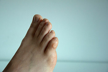 Corns and Calluses treatment in the Queens County, NY: Ozone Park (Forrest Hills, Howard Beach, Jamaica, East New York, Hollis, Laurelton, Flushing, Elmhurst, Elmont, Bushwick, Williamsburg) and Nassau County, NY: Manhasset (Great Neck, Garden City, Mineola, Westbury, Roslyn, Jericho, Hempstead, Hicksville, Glen Cove, East Meadow) areas