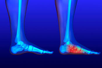 Flat feet and Fallen Arches treatment, Flatfoot Deformity Treatment in the Queens County, NY: Ozone Park (Forrest Hills, Howard Beach, Jamaica, East New York, Hollis, Laurelton, Flushing, Elmhurst, Elmont, Bushwick, Williamsburg) and Nassau County, NY: Manhasset (Great Neck, Garden City, Mineola, Westbury, Roslyn, Jericho, Hempstead, Hicksville, Glen Cove, East Meadow) areas