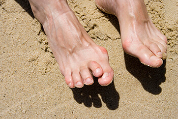 Hammertoes & Mallet Toes treatment in the Queens County, NY: Ozone Park (Forrest Hills, Howard Beach, Jamaica, East New York, Hollis, Laurelton, Flushing, Elmhurst, Elmont, Bushwick, Williamsburg) and Nassau County, NY: Manhasset (Great Neck, Garden City, Mineola, Westbury, Roslyn, Jericho, Hempstead, Hicksville, Glen Cove, East Meadow) area