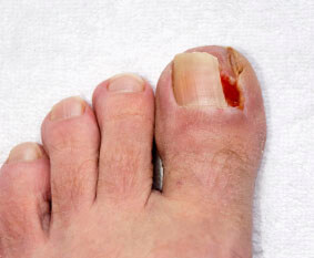 Ingrown toenails treatment in the Queens County, NY: Ozone Park (Forrest Hills, Howard Beach, Jamaica, East New York, Hollis, Laurelton, Flushing, Elmhurst, Elmont, Bushwick, Williamsburg) and Nassau County, NY: Manhasset (Great Neck, Garden City, Mineola, Westbury, Roslyn, Jericho, Hempstead, Hicksville, Glen Cove, East Meadow) areas