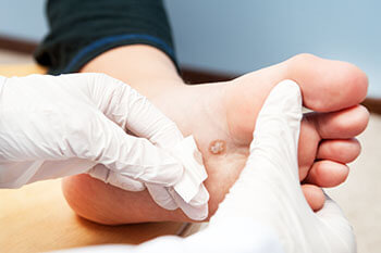 Plantar warts treatment in the Queens County, NY: Ozone Park (Forrest Hills, Howard Beach, Jamaica, East New York, Hollis, Laurelton, Flushing, Elmhurst, Elmont, Bushwick, Williamsburg) and Nassau County, NY: Manhasset (Great Neck, Garden City, Mineola, Westbury, Roslyn, Jericho, Hempstead, Hicksville, Glen Cove, East Meadow) areas