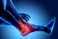 What Is Tarsal Coalition?
