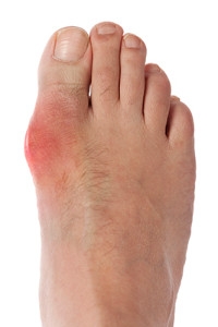 Myths Associated with Gout